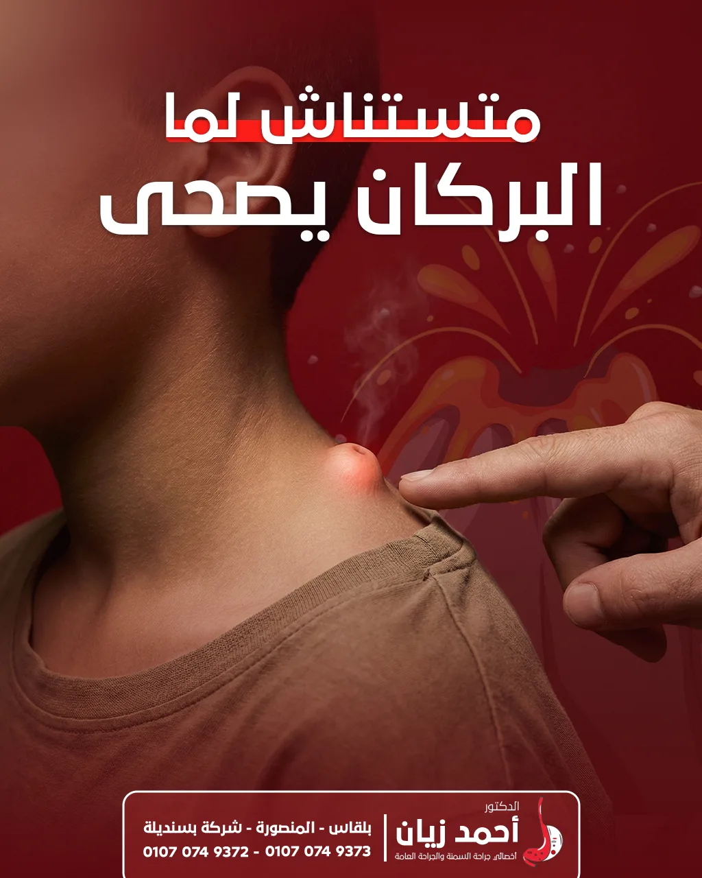 cyst